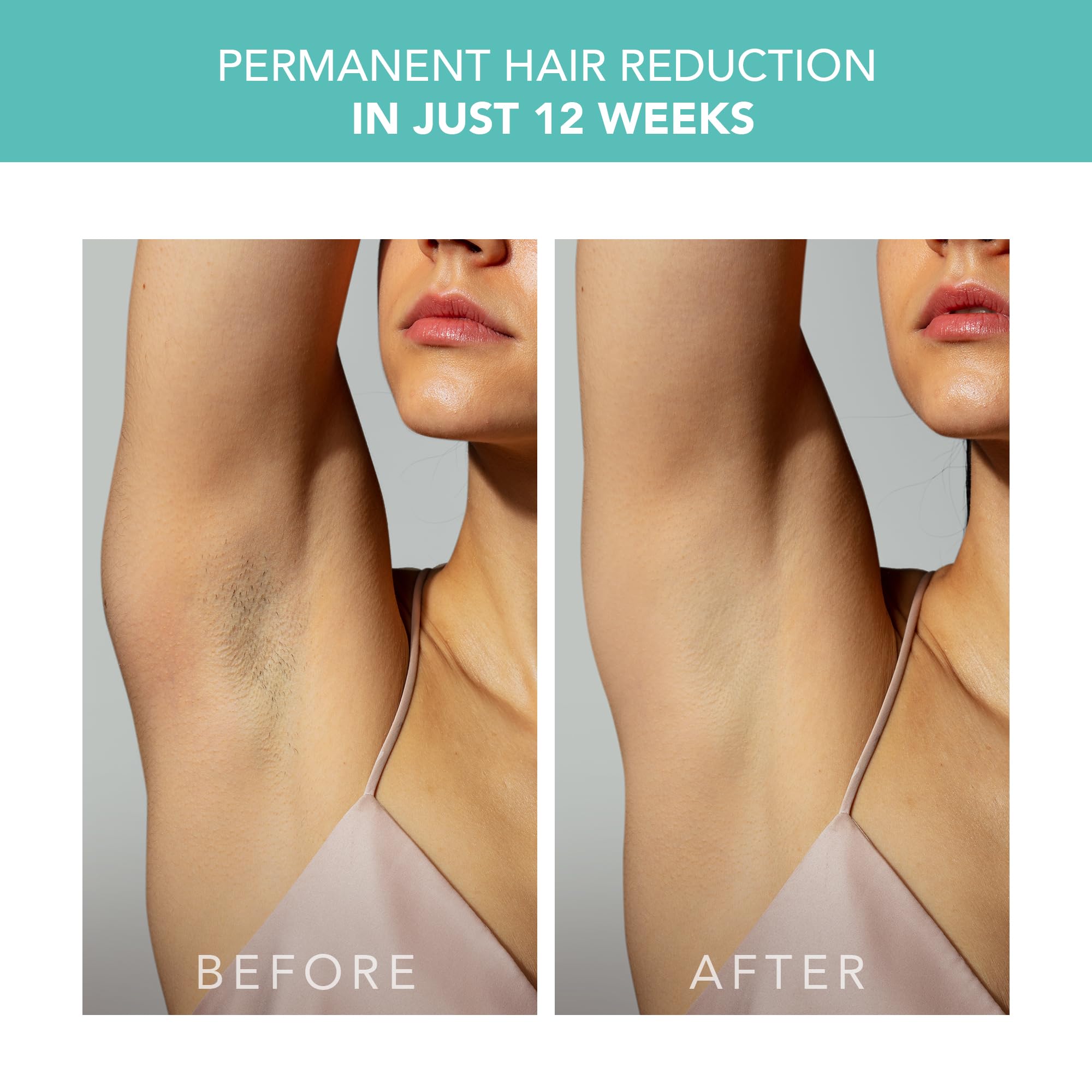 FOREO PEACH 2 IPL Hair Removal Device – Quick & Gentle Hair Reduction – For Full Body & Face – Skin Cooling System – Silicone Shield - Artic Blue