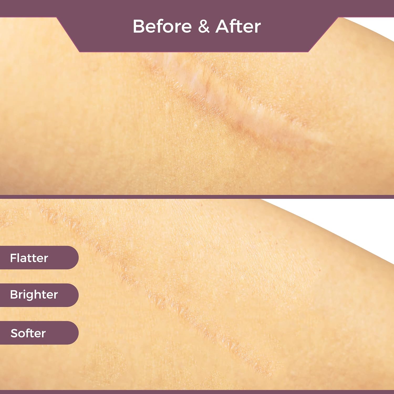 Jusore Silicon Scar Sheets - (4 cm x 300 cm roll) scar's reduction in scar Jusore Silicon Scar Sheets - (4 cm x 300 cm roll) scar's reduction in scar