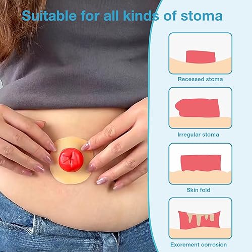 Miniatura 2 de 20 anillos moldeables de barrera para ostomía, anillos elásticos extensores de piel, suministros de bolsa de ostomía hidrocoloide médica de 0.079