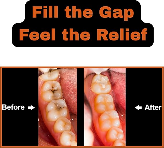 Temporary Filling Dental Repair Kit for Repairing Lost fillings and Loose caps, Crowns or Inlays | Tooth Filler