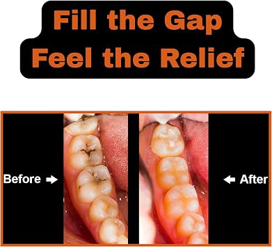 Temporary Filling Dental Repair Kit for Repairing Lost fillings and Loose caps, Crowns or Inlays | Tooth Filler