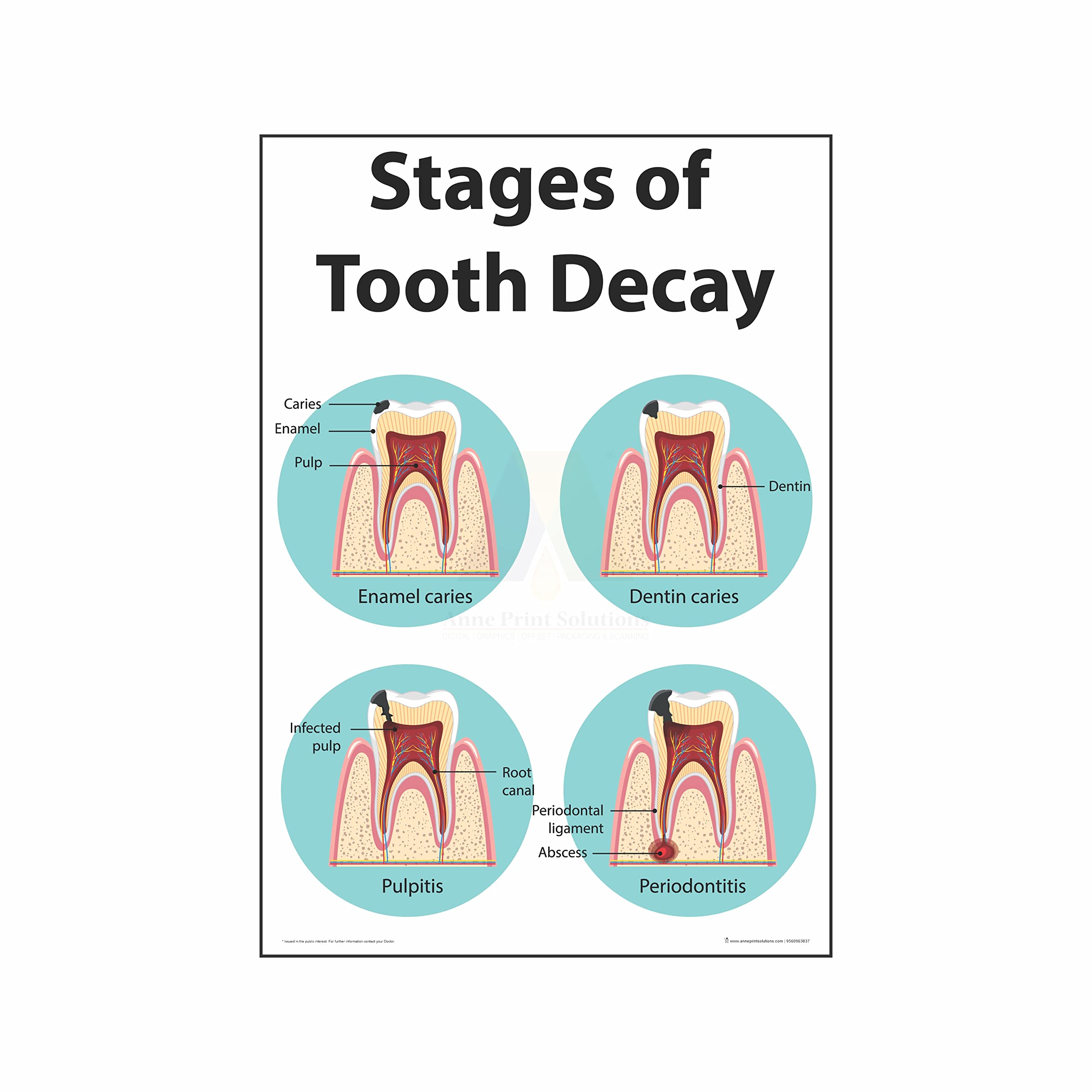 Buy Anne Print Solutions® Stages of tooth decay chart s For Hospital s