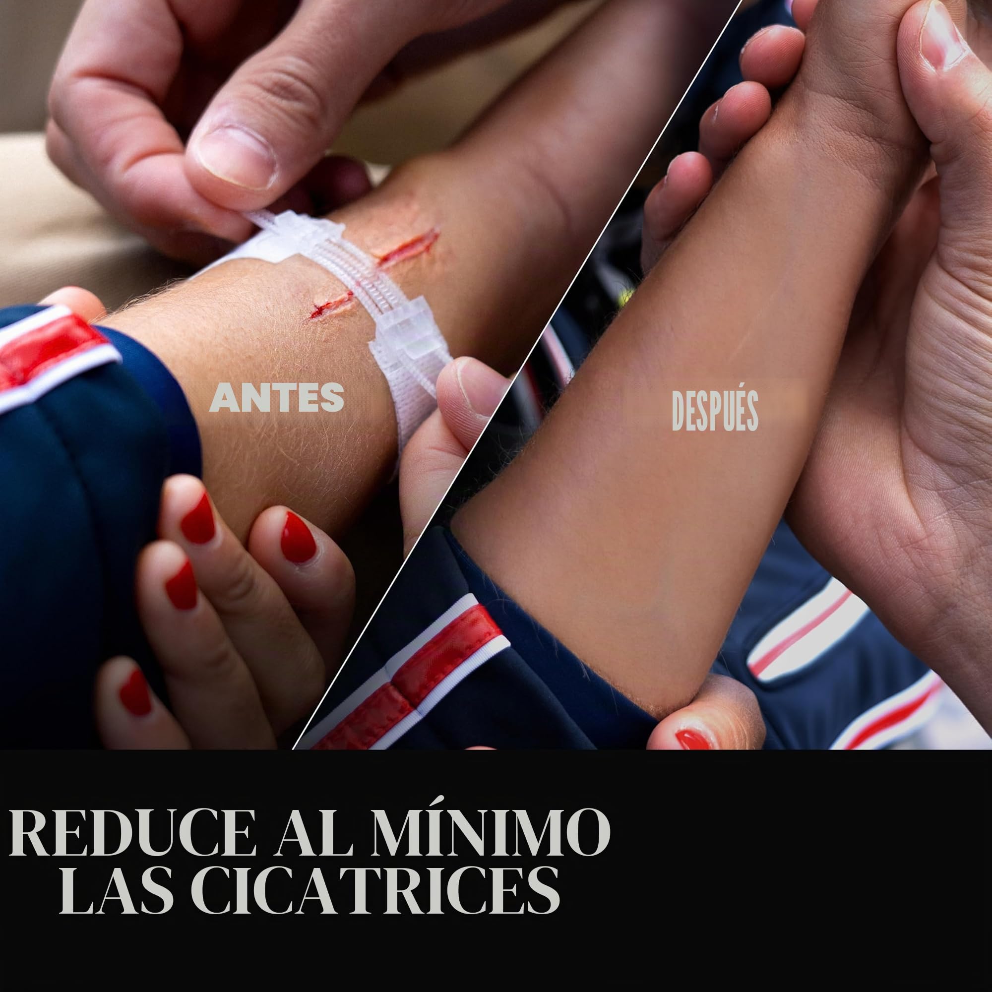 SurviveX Kit de cierre de herida de punto de cremallera, no necesita puntadas | Cerrar heridas sin agujas ni puntadas, no invasivo para usuarios sensibles, fácil de usar, tensión ajustable
