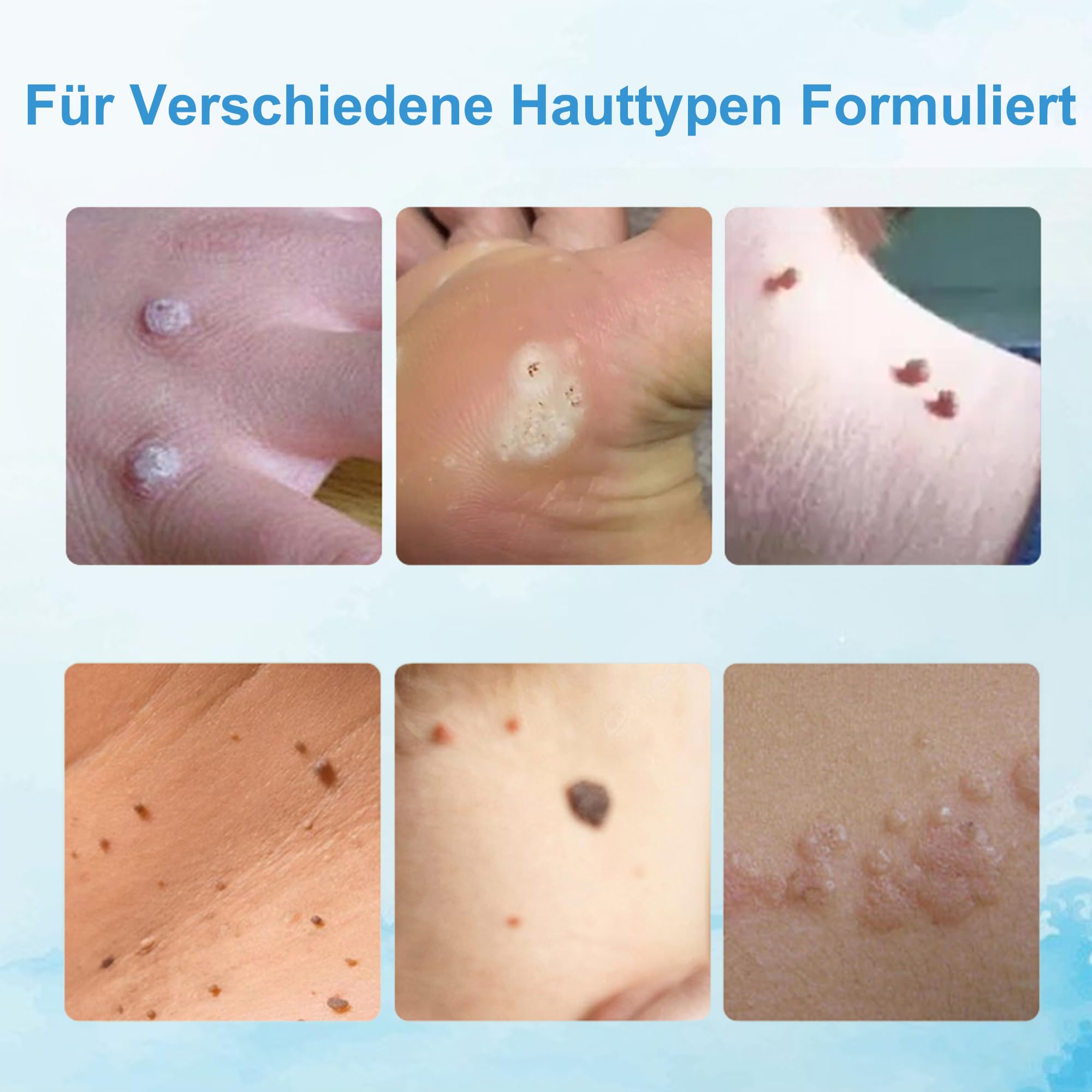 Warzenentfernungscreme für Gesicht und Körper - 20g