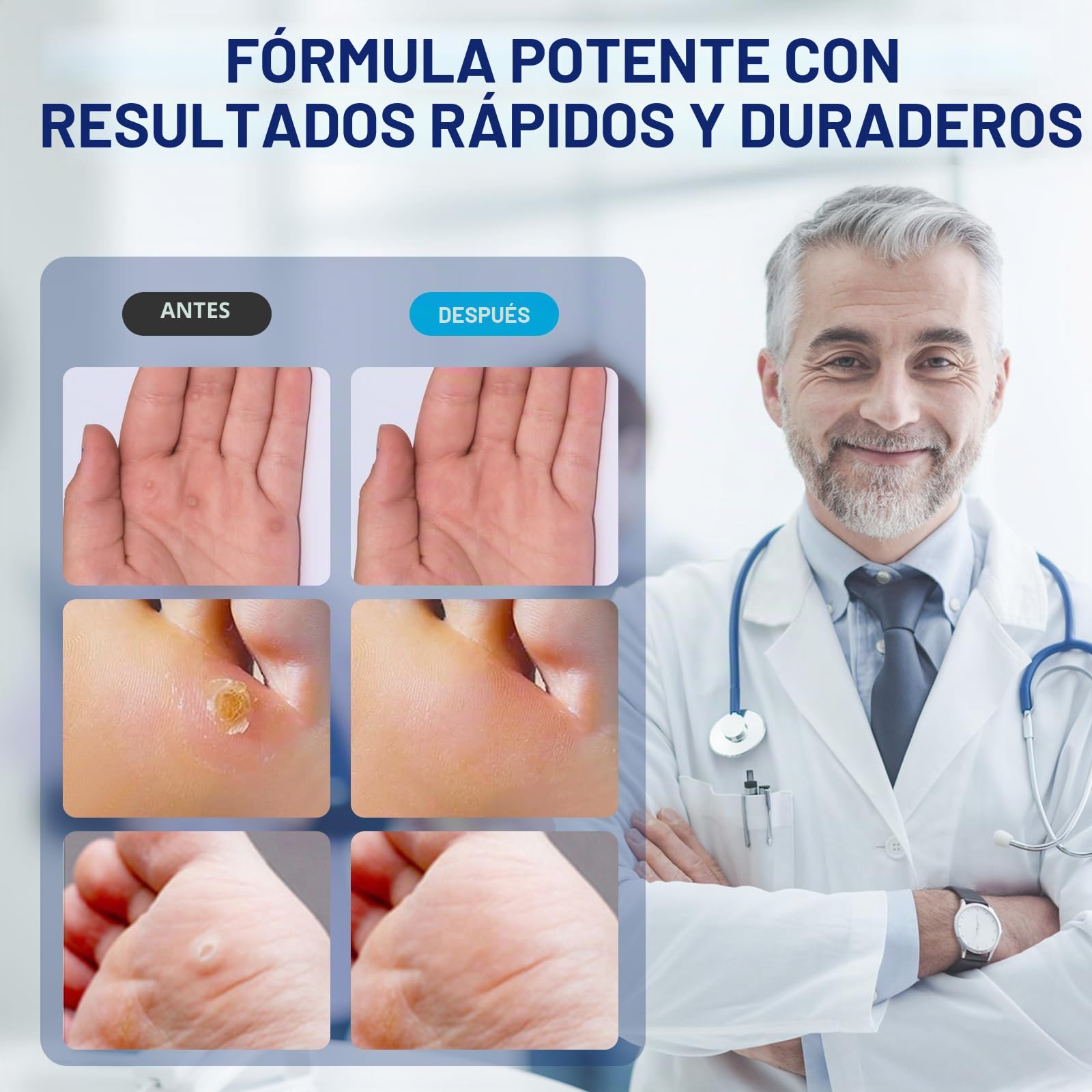 MYMULIKE Liquid WART&CORN REMOVER, 15 ml Wart Remover, Solución contra callos y callosidades, eliminador de verrugas, alivio del dolor de maíz y cuidado de los pies, eliminación de verrugas