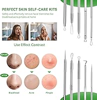 Vista 3 de Kit de herramientas para reventar espinillas, herramienta para eliminar puntos negros, 5 piezas, herramienta extractora de puntos negros para cara
