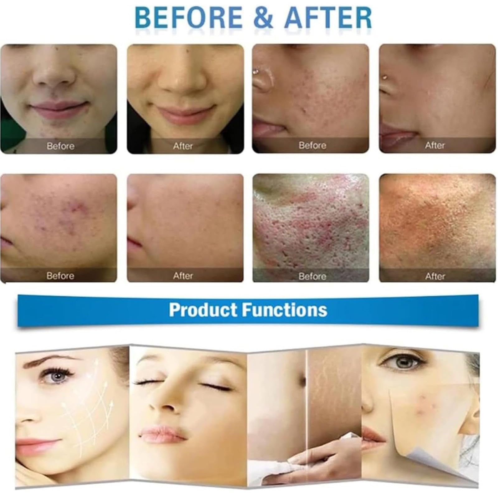 Máquina De Estiramiento Facial con Microagujas De Radiofrecuencia Fraccionada para Terapia De Eliminación De Arrugas,Belleza Facial,para Rejuvenecimiento Piel Y Eliminación De Estrías