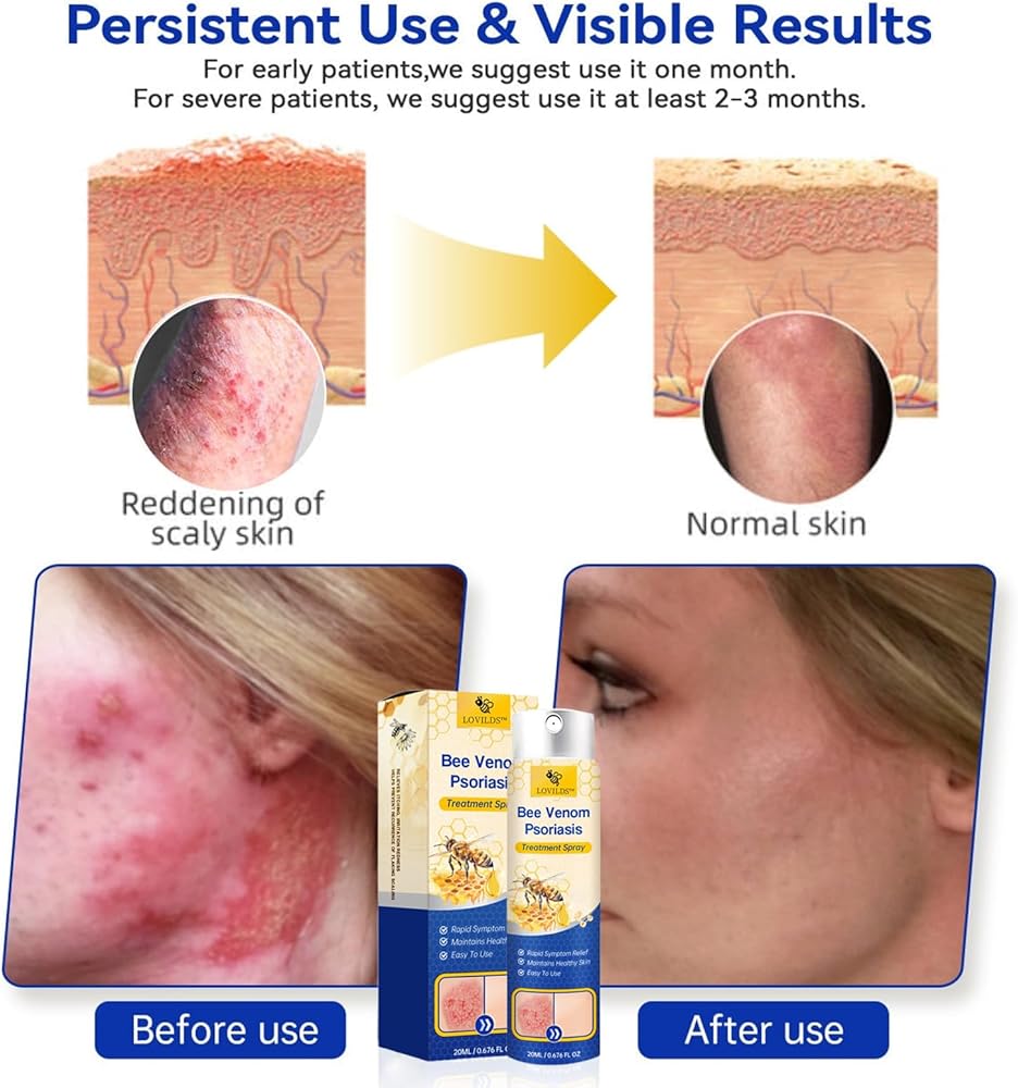 Spray Apaisant PsoriaHeal Bee Care Pro - 20 Ml - Soulage Démangeaisons Et Répare La Peau - Formule 2024 Tous Types De Peau