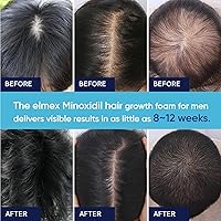 Vista 5 de Espuma de Minoxidil 5% para Hombres y Mujeres, Espuma de Minoxidil 5% para Hombres, Minoxidil para el Crecimiento del Cabello de Mujeres (60ML)