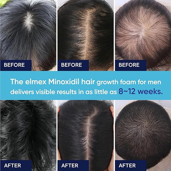 5% Minoxidil Foam for Men, Minoxidil for Men Foam, Minoxidil for Women Hair Growth with Biotin & Castor Oilfor Thicker, Fuller Hair, Fast-Absorbing Formula 120ml - 2 packs