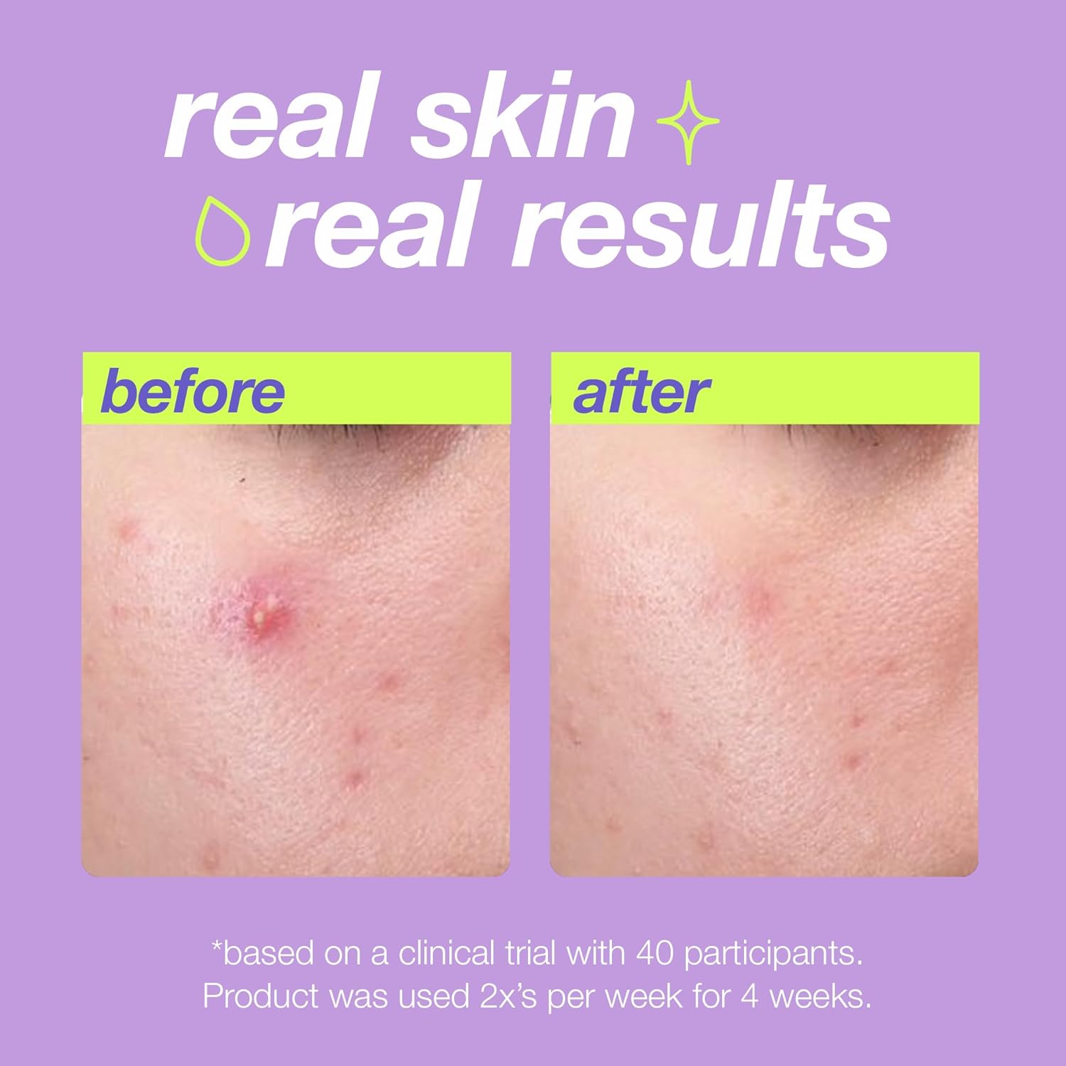 Clear Start Breakout Clearing Liquid Peel with AHAs and BHAs