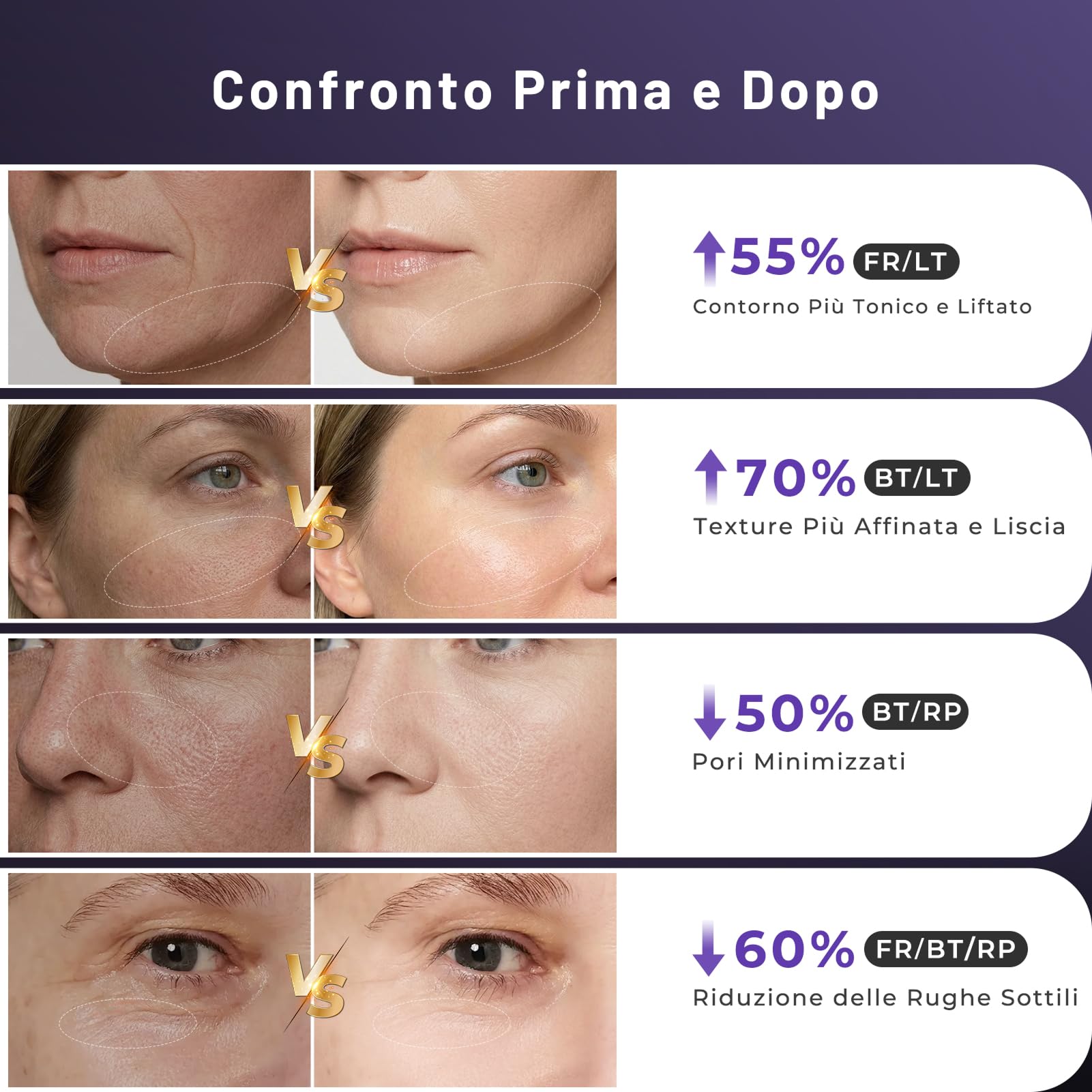Radiofrequenza Viso Professionale, Microcorrente Massaggiatore Viso, Dispositivo Elettrico di Bellezza Antirughe, Antietà, Anti-Acne, Lifting e Rassodante per Viso e Collo (Viola)