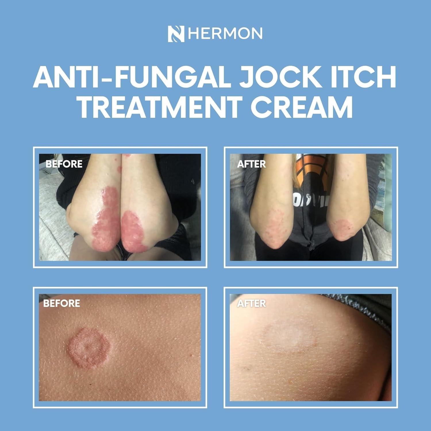 Hermon Jock Itch Antifungal Cream, Ringworm Treatment for Humans, Athlete's Foot Treatment, Ringworm Cream for Humans, Foot & Body Balm, Provides Soothing Relief-2 Pack — Amazon image 6