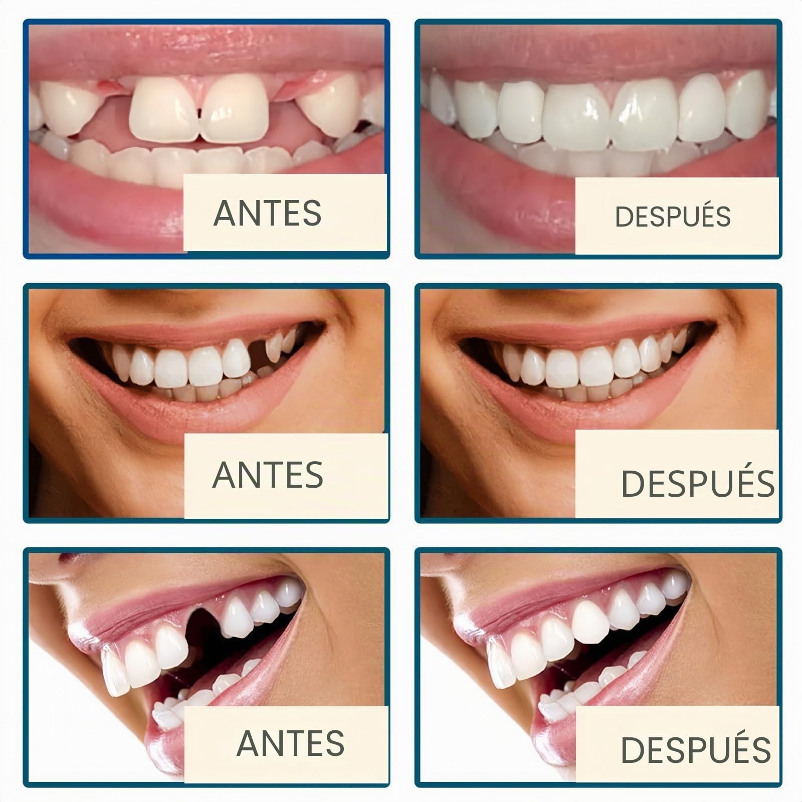 Prótesis dentales completas, solución flexible de última generación para prótesis completas, ideal para mayor comodidad y estética, dientes cómodos y de aspecto natural (2pcs)