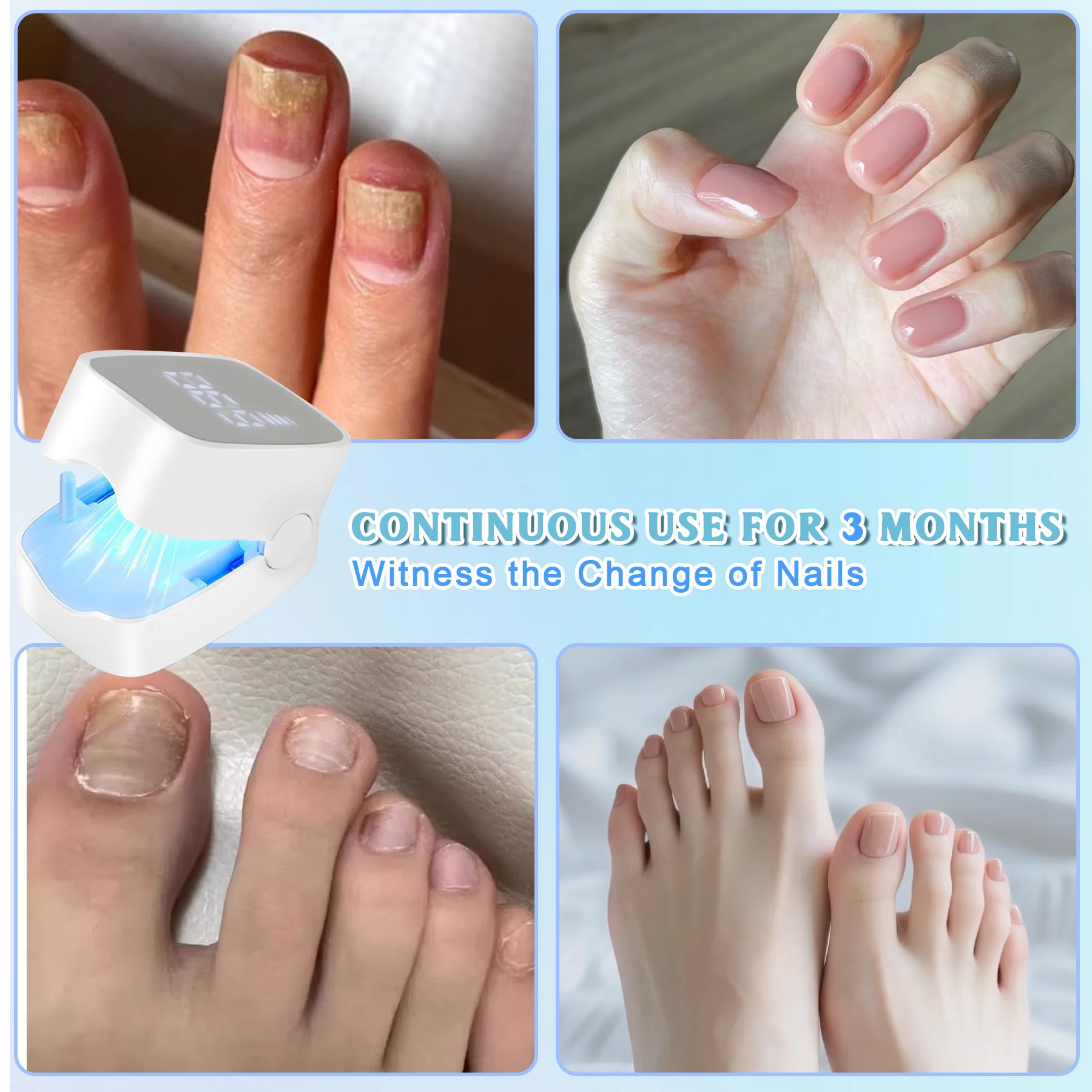 Appareil Laser Traitement Mycose Ongles - Neuf, Antifongique, 1 Unité