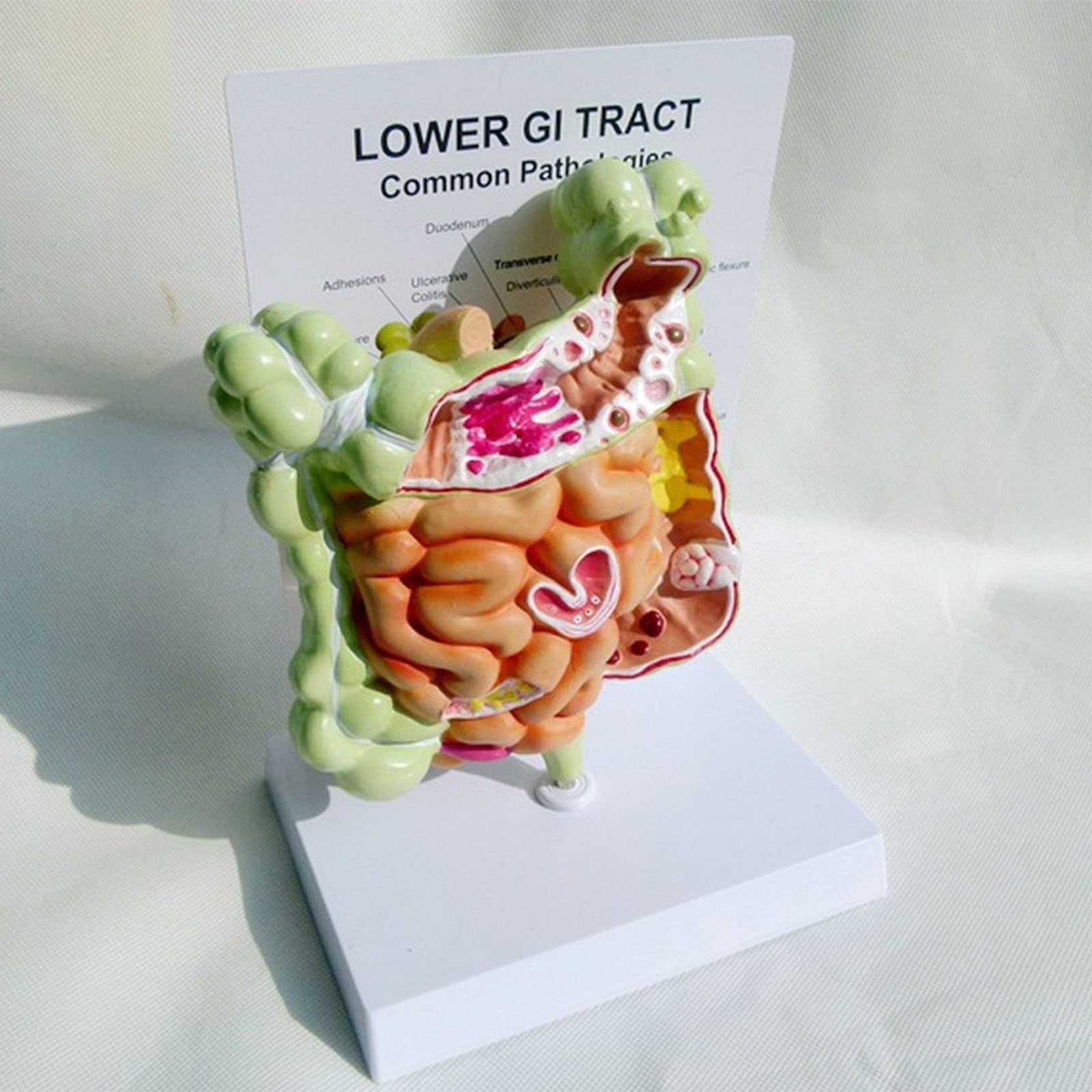 GTHTUHFD Human Large Intestine Pathology Model Human Digestive Model Gut Anatomy Intestinal Lesion Cecal Rectum Duodenal Ulcer