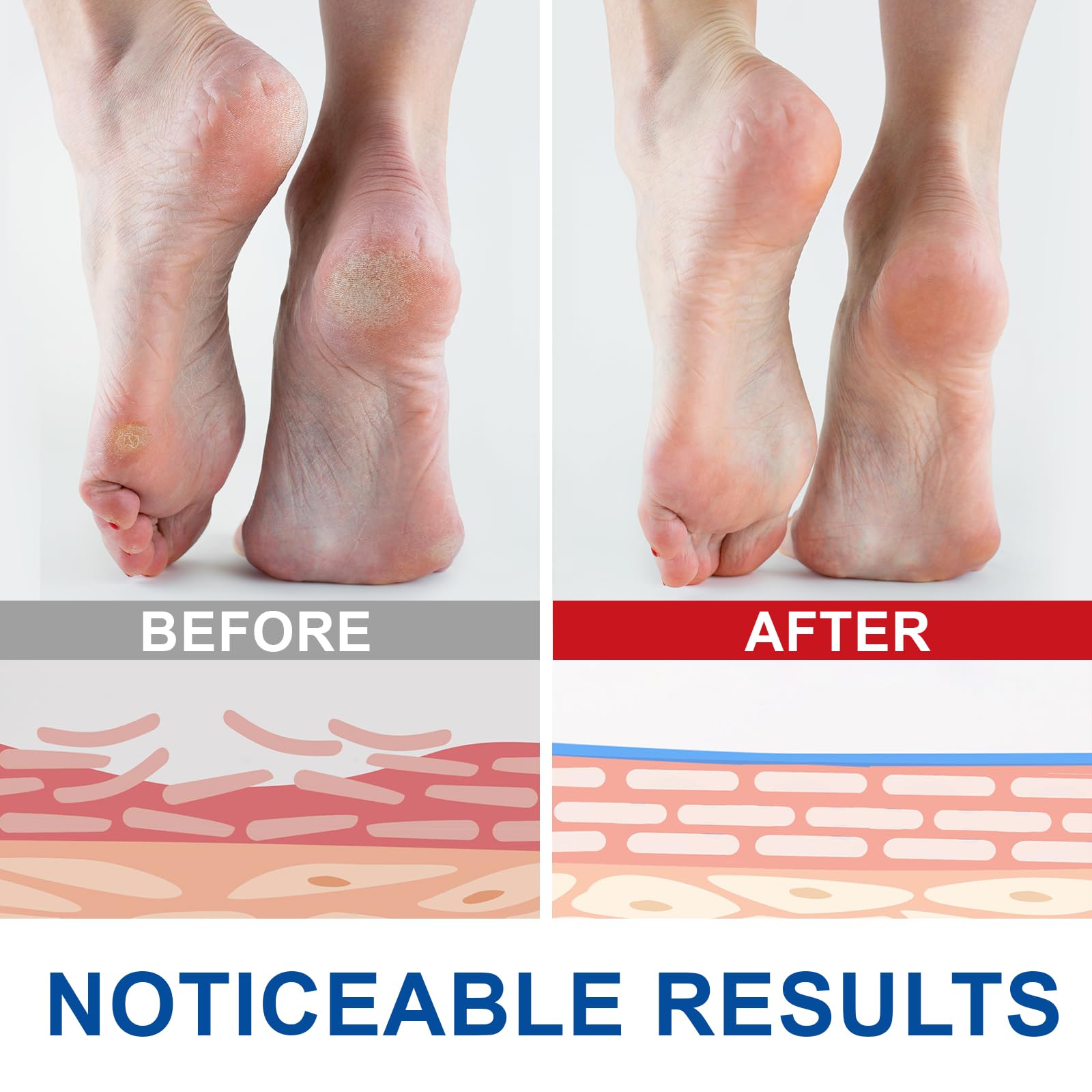 Foot Cream with Urea 60 Percent 2PCS, Cracked Heel Repair Cream - Image 3