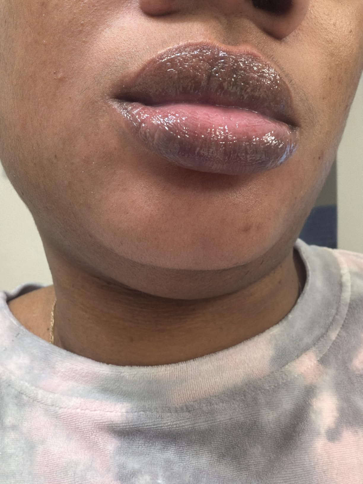 Generic Lip Lightening for Dark Lips, Lip Brightening for Dark Lips, Dark Lip Treatment Serum for Smokers, Dry or Uneven, Restores Natural Look & Moisture with VC, Licorice & Jojoba Seed Oil