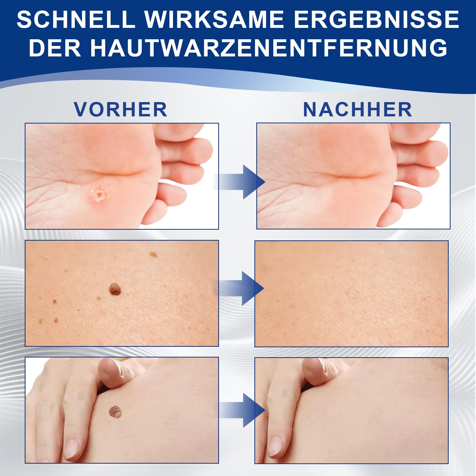 Acción para eliminar acrocordones – Pipeta de precisión para rostro y cuerpo | Eliminación específica de verrugas plantares, vulgares y planas | Fórmula suave con, Sin Dolor | Formato de viaje (10 ml)
