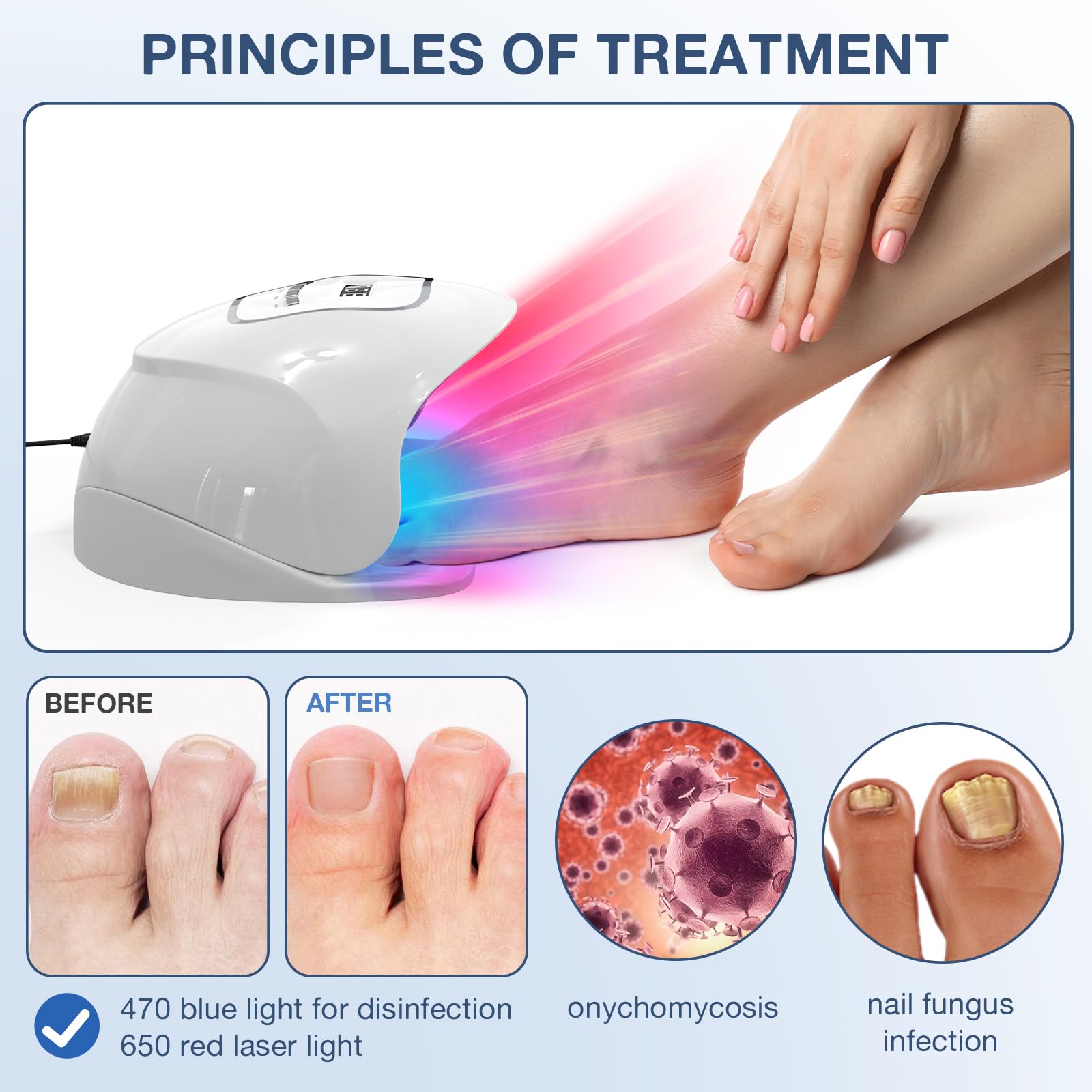iKeener Dispositivo laser per funghi del chiodo, approvato dalla FDA, pulizia delle unghie e onicomicosi, rimozione funghi con luce blu 15 x 470 nm + 30 x 650 nm luce rossa, sessioni