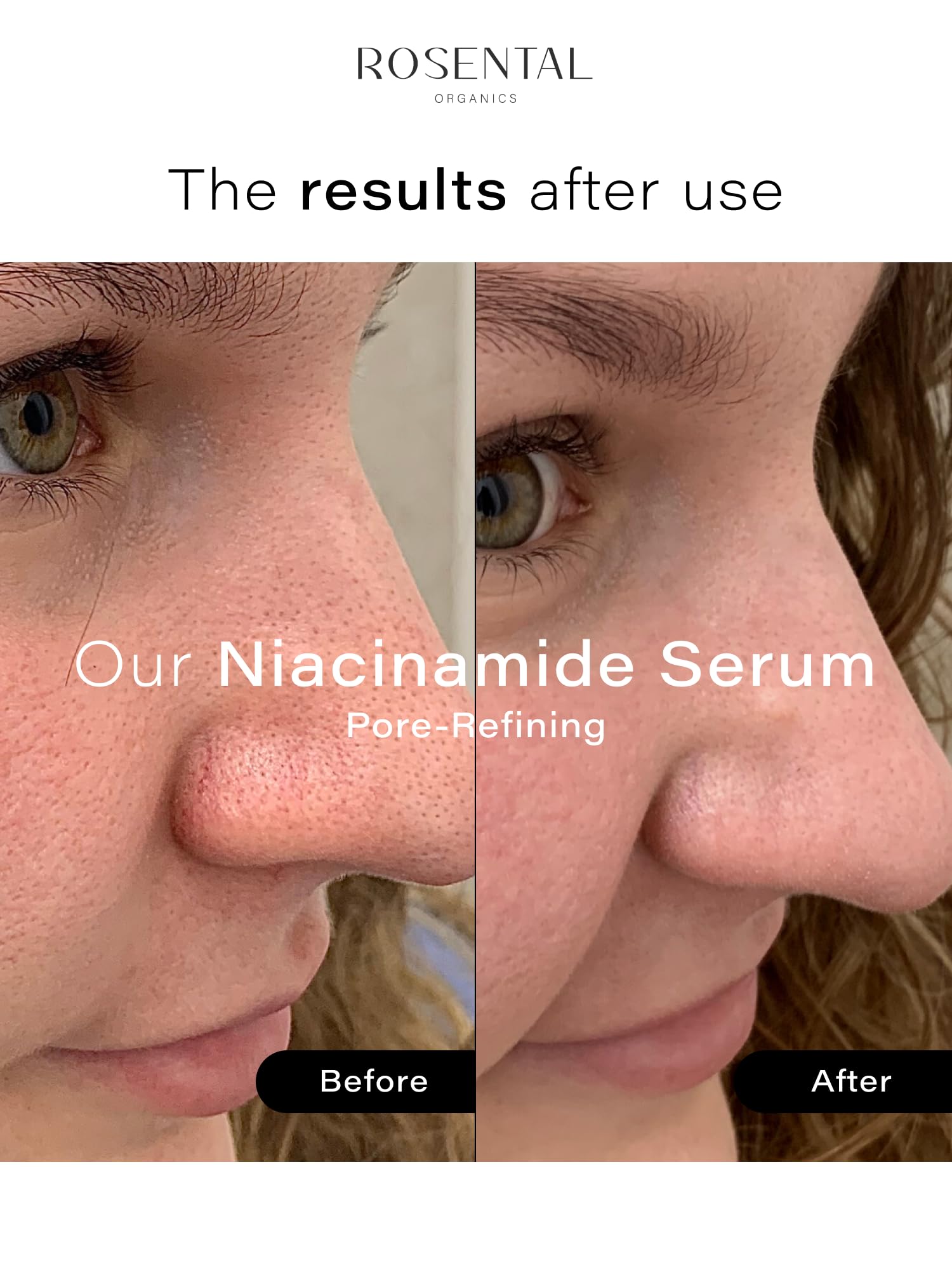 Rosental Organics Niacinamide+ serum do oczyszczania porów – 5% niacynamidu i kwasu azelainowego do rozjaśniania plam pigmentowych i blizn potrądzikowych