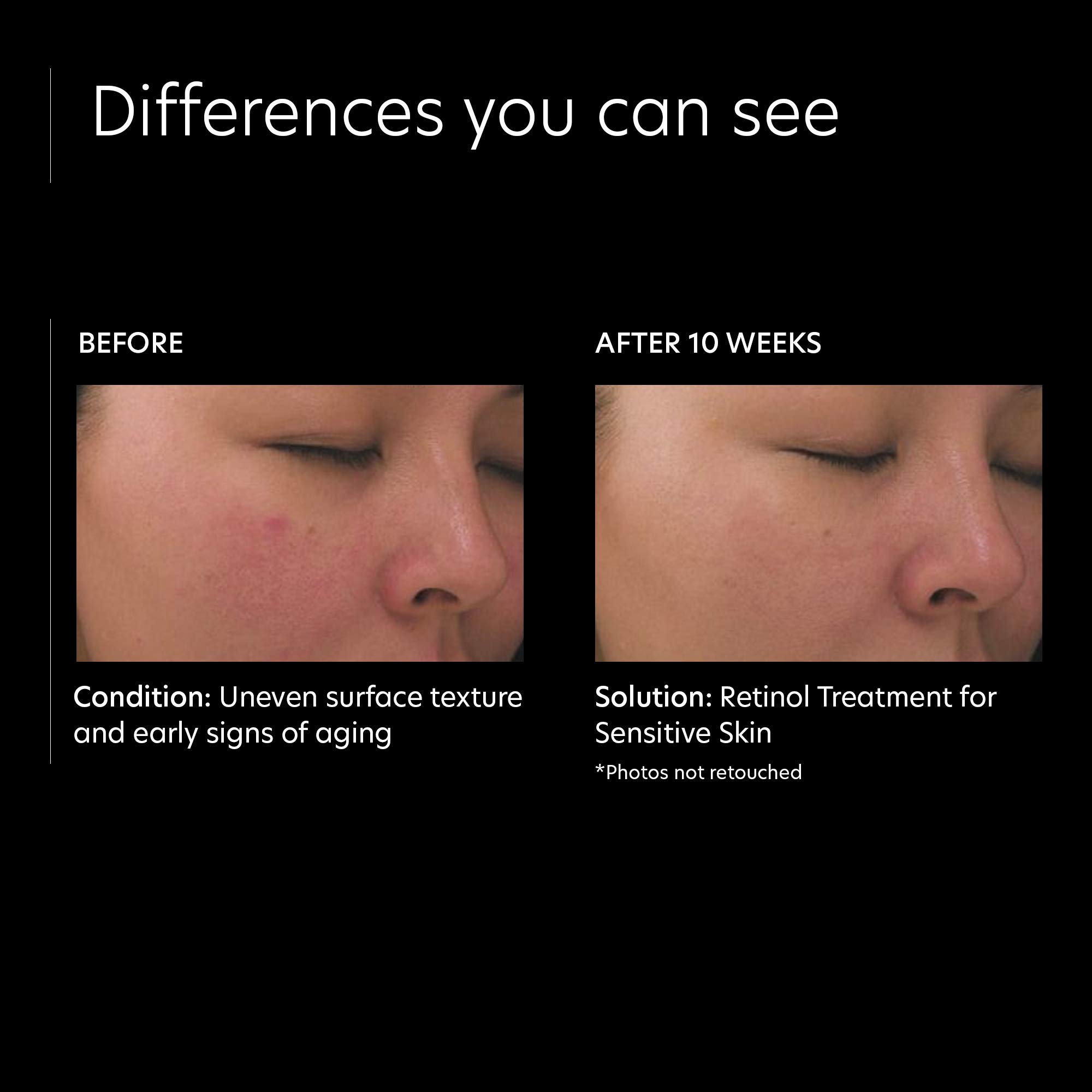 PCA SKIN Retinol Treatment for Sensitive Skin - Anti Aging Face Serum to Gently Reduce Redness & Minimize Fine Lines & Wrinkles - Contains Vitamin A & Hydrating Niacinamide (1 oz)