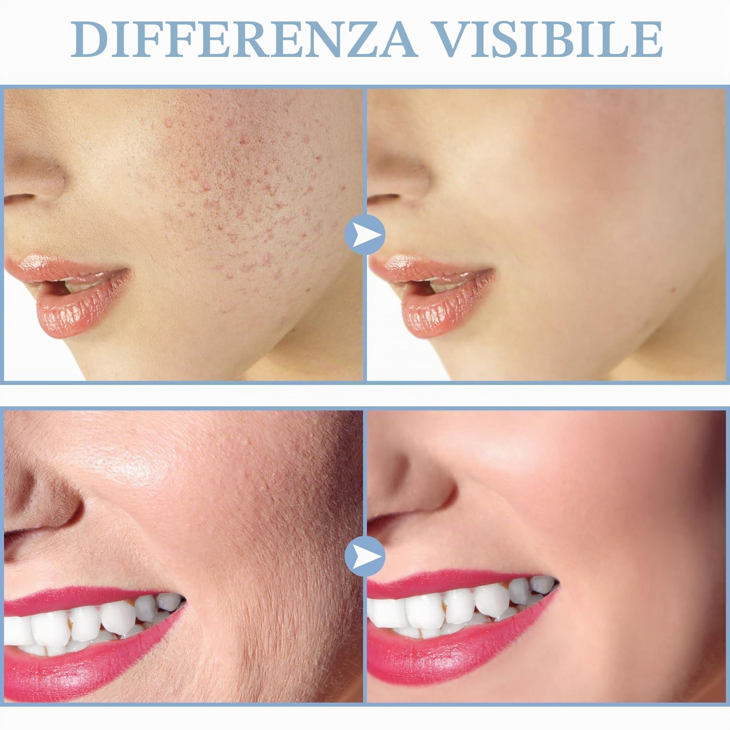 Portatile Alta Frequenza Viso Professionale - TUMAKOU 4 in 1 Elettroterapia Massaggiatore Facciale per Rimozione dell'Acne, Rughe, Linee Sottili, Gli occhi gonfi, Rafforzamento della pelle