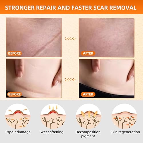 Miniatura 3 de Hojas de silicona para cicatrices (rollo de 1.6 x 79 pulgadas, 6.6 ft), tiras de silicona reutilizables para cicatrices, cintas de silicona suave