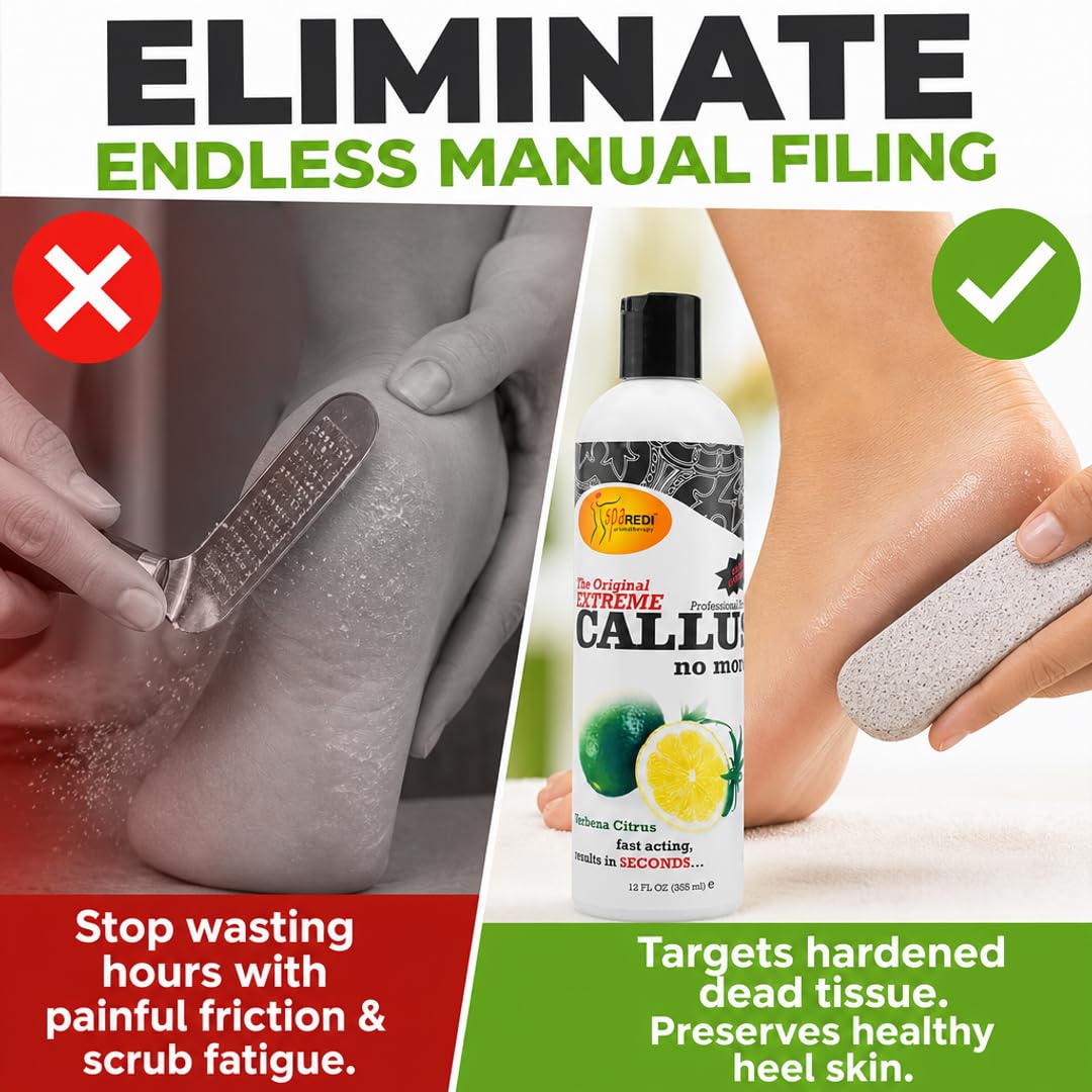 Amazon.com : SPA REDI Callus Remover Gel – Fast-Acting Pedicure