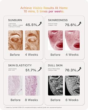 Lumefu Nimbus PRO Red Light Therapy for Face - FDA Cleared LED Face Mask Light Therapy, Full Near Infrared Red Light Therapy Mask with 420 LEDs 820nm NIR for Anti-Aging, Wrinkle, Cordless Gift