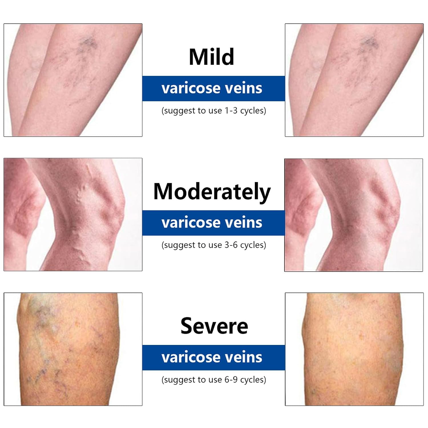 Vein Target Microdarts Patches for Legs,Relieve Leg Discomfort, Improves Blood Circulation, Natural Ingredients Leg Treatment for All Skin Types(1 Pack)
