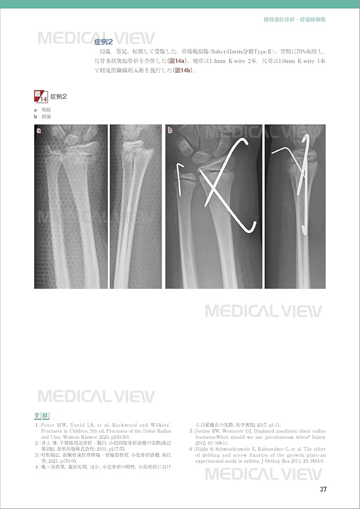 新OS NEXUS No.15 小児の骨折と手術 m3電子書籍 | 新OS NEXUS No.15 小児の骨折と手術［Web動画付］