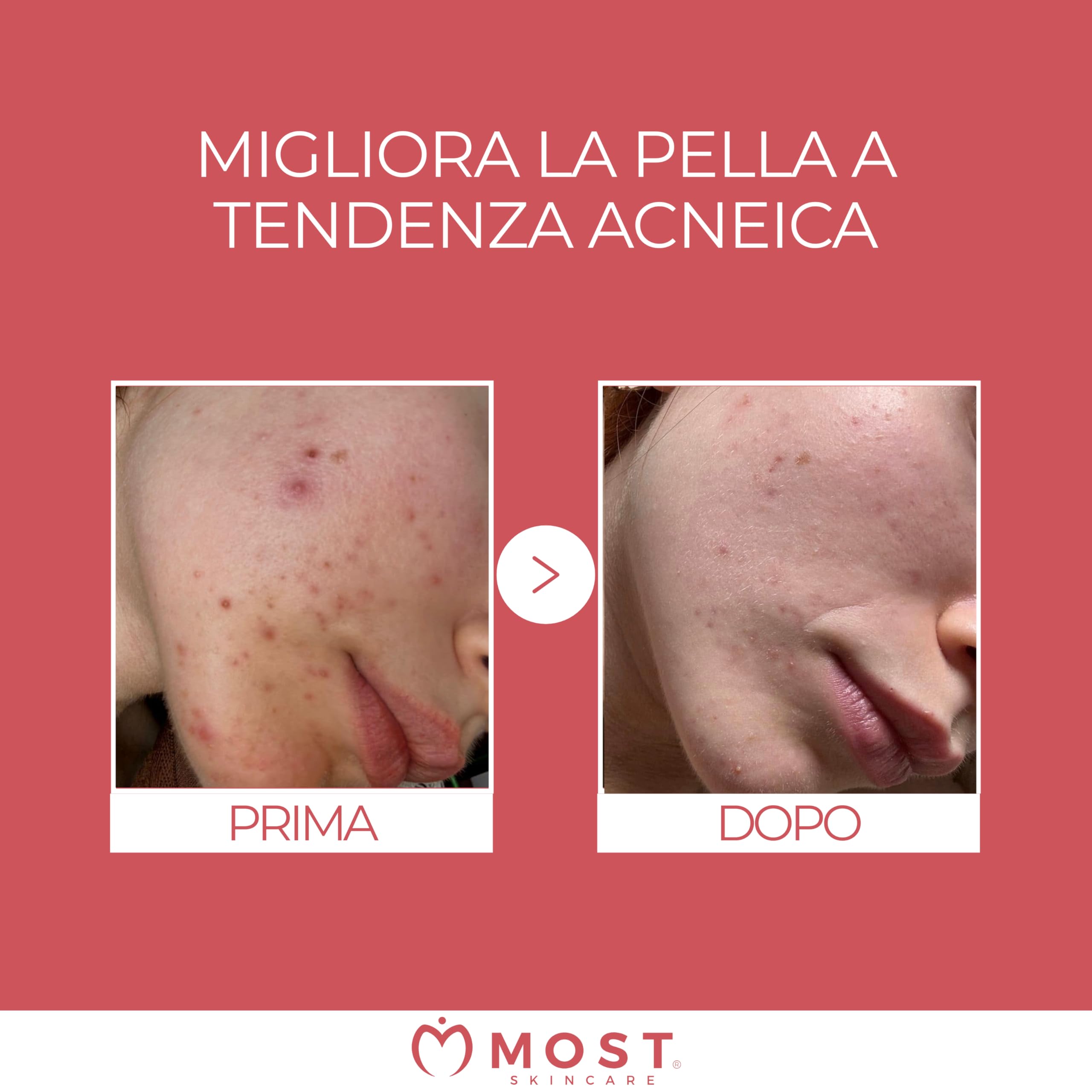 MOST - Glicosal Esfoliante Viso Micropeeling, Lozione con Acido Salicilico e Acido Glicolico - Delicata Azione Peeling Viso e Anti Macchie, Pelle a Tendenza Acneica, Impura, Melasma, Imperfezioni 50ml