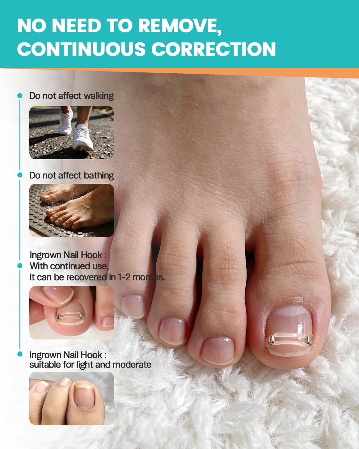 BEZOX Correcteur d'ongles incarnés, application facile à la maison