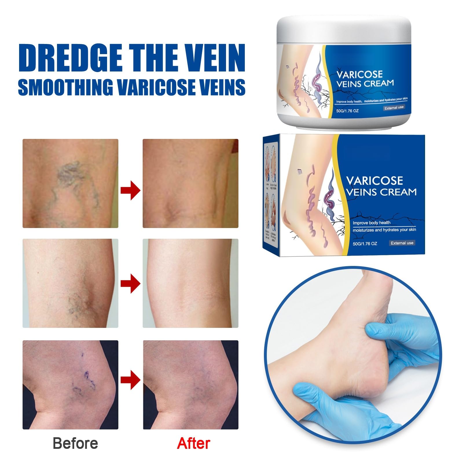 Crema per Vene Varicose,Crema per Vene Varicose Gambe,Cremas Lenitiva per Gambe,Cremas Trattamento Delle Venes Varicoses,50G