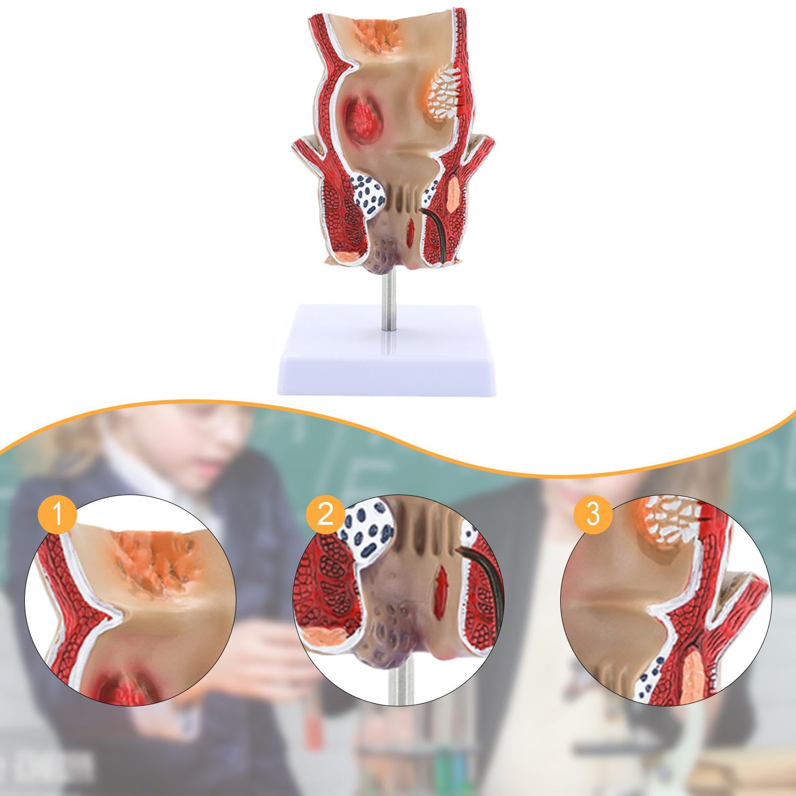 F Fityle Modelo de patología de hemorroides rectales, Material didáctico, Modelo anatómico, Herramienta de exhibición para el Aprendizaje científico.