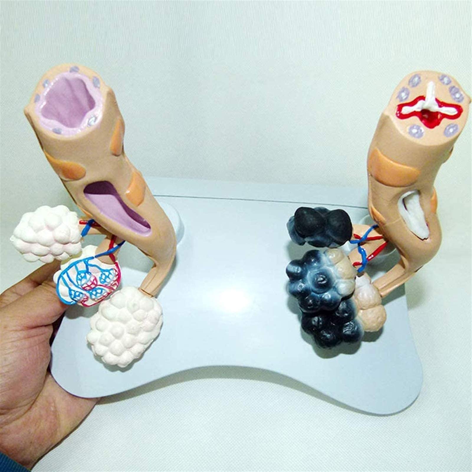Buy Anatomy Model, Comparative Smoking Alveoli and y Alveoli Anatomical