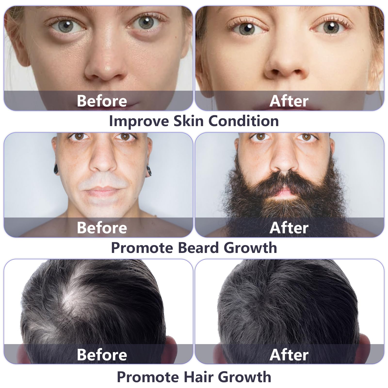 GeeRic 2Pzas Dermaroller Microagujas,0.3mm Rodillo Derma para Cicatrices de Crecimiento de Barba y Cicatrices de La Piel de La cara Rodillo de Barba Rodillo Facial Poro Contractivo