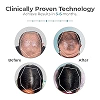 Vista 2 de Capillus Ultra Mobile Laser Therapy Cap for Hair Regrowth, with 82 Red Light Lasers for Laser Hair Growth, Red Light Hair Growth