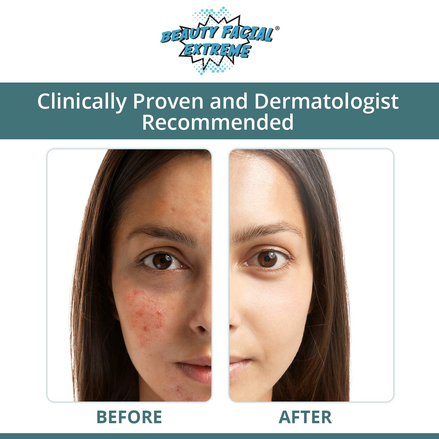 Acne Treatment Clay Mask Clears Away Clogged Pores, Blackhead