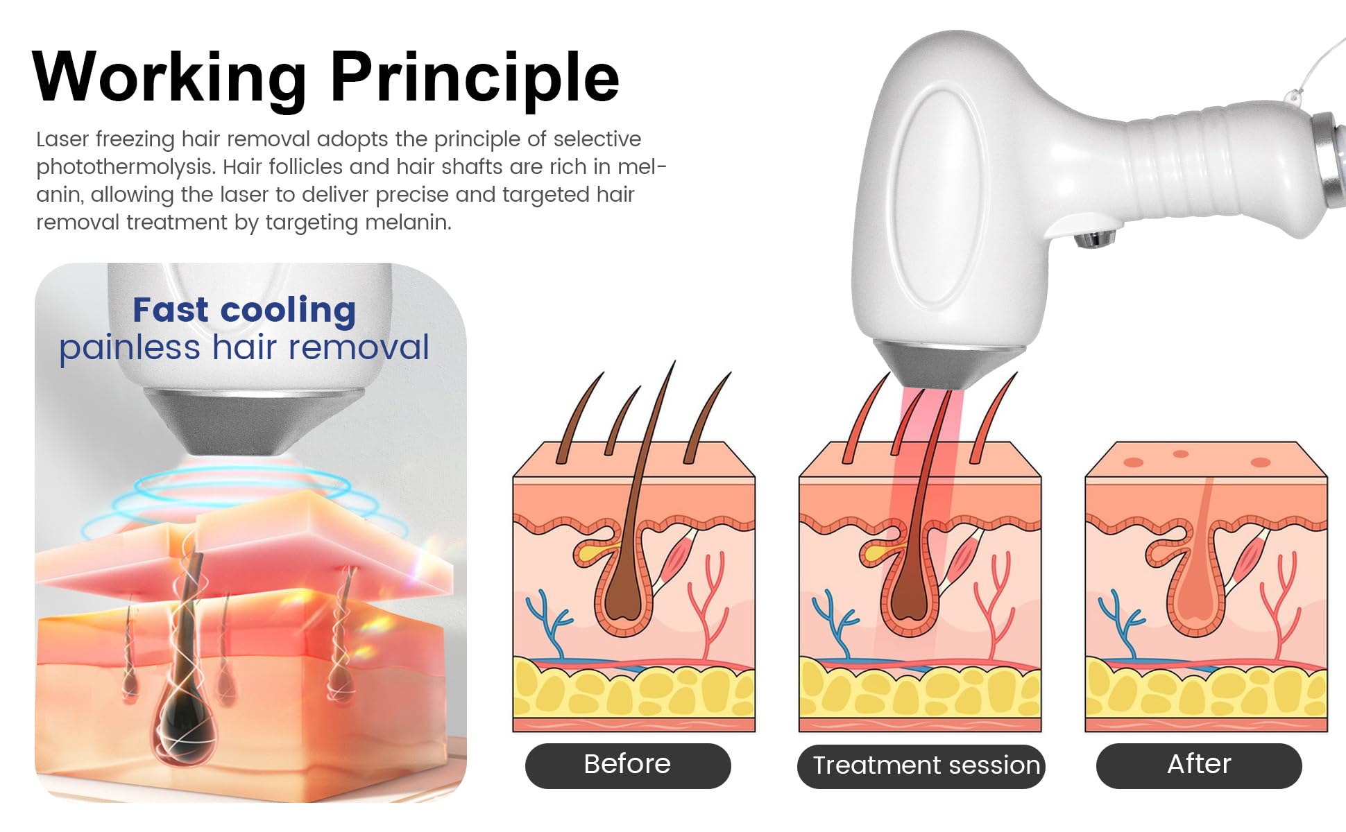 Apparecchiatura professionale per la depilazione con laser a diodi 808, | Regolabile in tre modalità, utilizzabile su braccia, gambe, schiena, ascelle e zona bikini, ecc., bianco