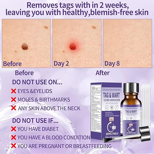 Miniatura 5 de ANTIXYL Kit líquido de eliminación de manchas cutáneas, removedor de maíz de verrugas, de acción rápida, congelación, 8% de eliminación de verrugas