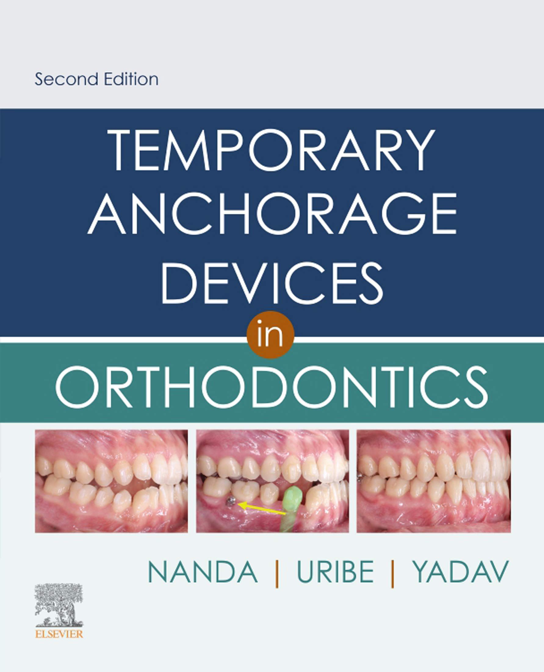 Temporary Anchorage Devices in Orthodontics E-Book (English Edition)