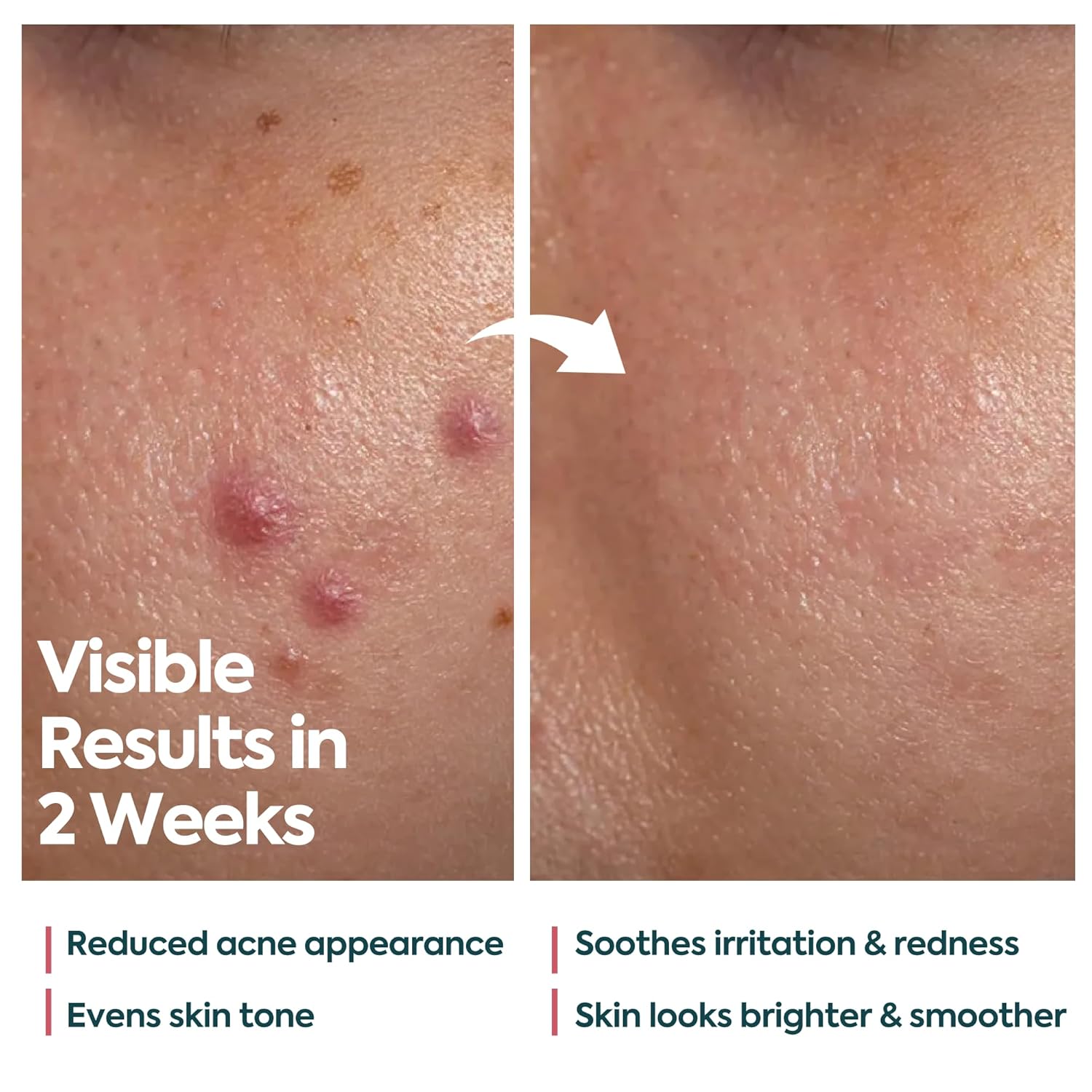 Acne Cream for Face – Spot Treatment for Pimples & Acne Scars – Salicylic Acid & Niacinamide for Scar Removal – Teen & Adult Skincare with Zinc PCA - Image 8