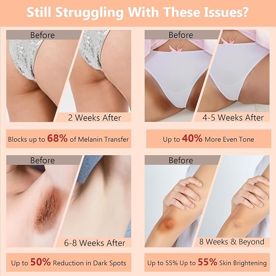 Skin Bleaching Cream for Body-Dark Spots Remover Lightening Cream & Uneven Tone Nourishing Formula Bleaching Intimate Areas & Underarms Inner Thigh, Bikini Line, Armpit Knees Elbows for All Skin Types