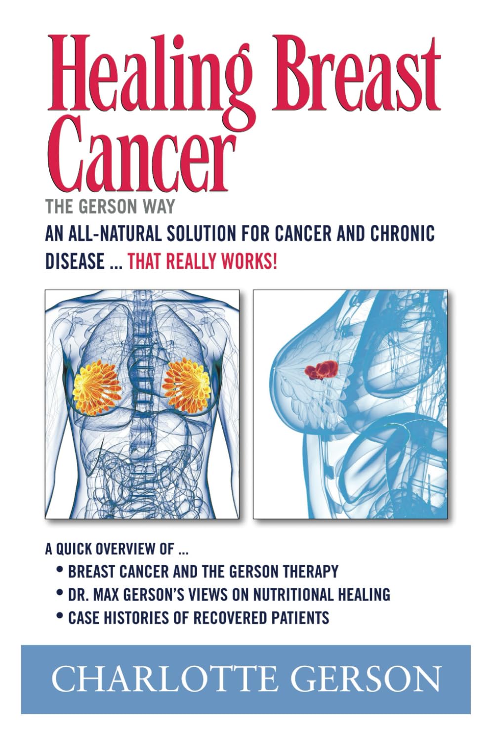 Healing Breast Cancer - The Gerson Way