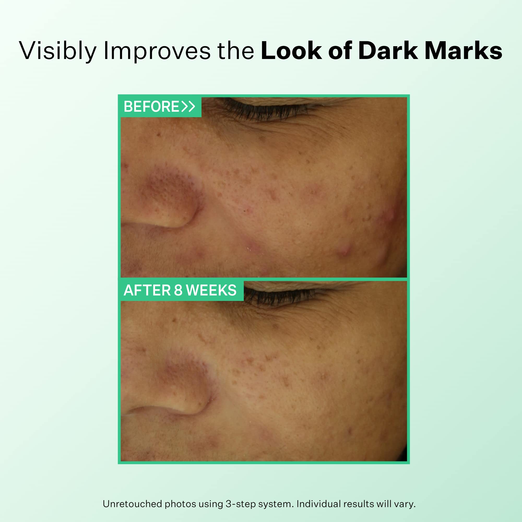 StriVectin Multi Action Clear for Acne and Blemish Prone Skin for Clearer, Smooth and Brighter Skin, Less Breakouts and Pimples for Healthy Looking Skin