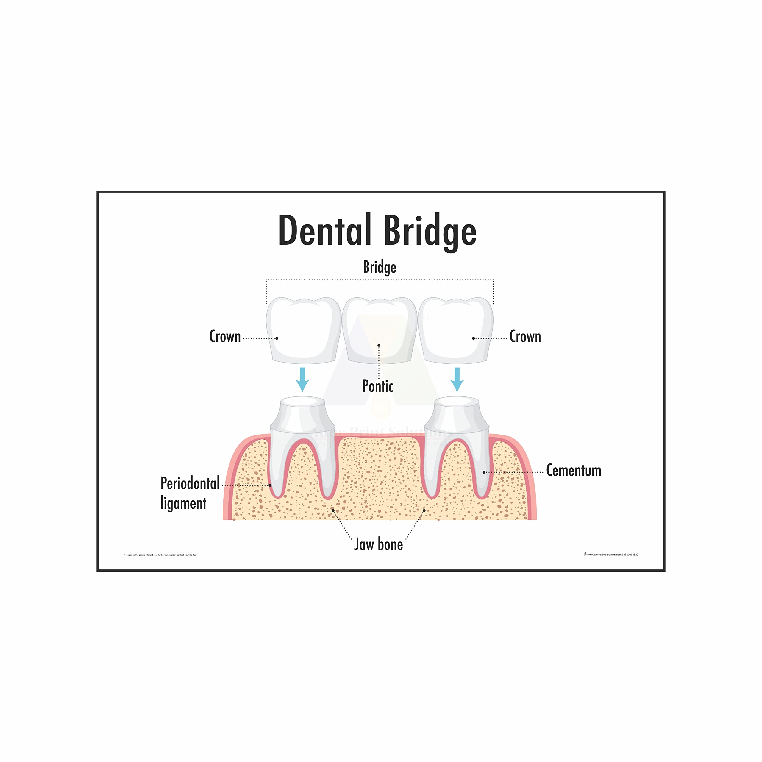 Dental Implant Chart Poster - Healthcare Reference -17
