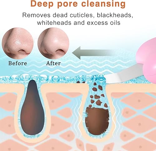 Miniatura 3 de Herramientas de eliminación de puntos negros, raspador de nariz para puntos negros, rascador de poros limpios, herramienta de limpieza profunda