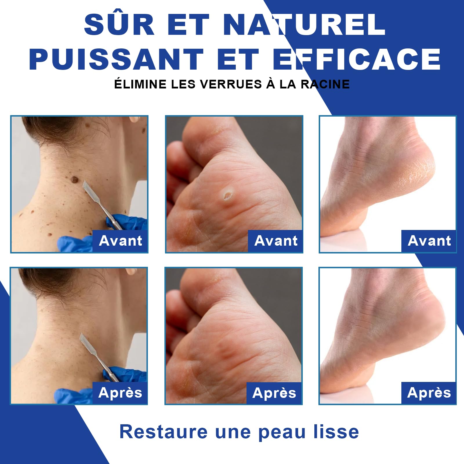 Stylo anti-verrues 2Pcs (4ml) pour le corps et les mains